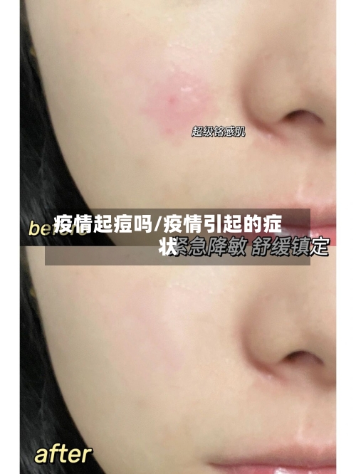 疫情起痘吗/疫情引起的症状